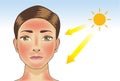 UV ray from sun made the redness appear on woman facial and neck skin. Royalty Free Stock Photo