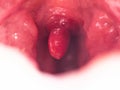 Uvulitis and sore throat in the oral cavity due to illness. Inflammation of the uvula and tonsils due to infections