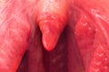 Uvulitis and sore throat in the oral cavity due to illness. Inflammation of the uvula and tonsils due to infections