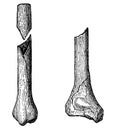 V-shaped fracture of the lower part of the tibia.