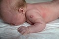 Vaccine for tuberculosis disease on newborn baby