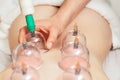 Vacuum medical cups on back Royalty Free Stock Photo