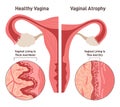 Vaginal atrophy. Thinning, drying and inflammation of the vaginal walls Royalty Free Stock Photo