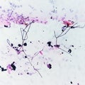 Vaginal Candidiasis, fungus infection in pap smear slide, vaginal candidiasis.