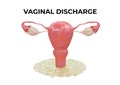 Vaginal discharge is excess fluid and cells from the vagina that ranges from whitish and sticky to clear and watery in color