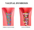 Vaginal dysbiosis. Dysbacteriosis of the vagina. Vaginitis Candidiasis. Lactobacillus, bifidobacteria. Bacteria pathogenic flora. Royalty Free Stock Photo