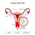 Vaginal infection and causative agents of vulvovaginitis. Royalty Free Stock Photo