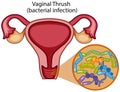 Vaginal Thrush on White Background