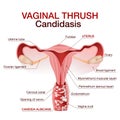 Vulvovaginal candidiasis or vaginal yeast infection.Vector illustration