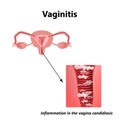Vaginitis. Inflammation in the vagina candidiasis thrush. The structure of the pelvic organs. Infographics. Vector