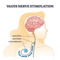 Vagus nerve stimulation as medical device implant for brain outline diagram