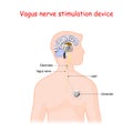 Vagus nerve stimulation device Royalty Free Stock Photo