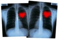 Valentines X-Rays - Love hearts
