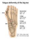 Valgus deformity of the big toe