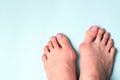 Valgus deformity. Flatfoot. Orthopedic problem and disease Royalty Free Stock Photo