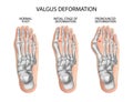 Valgus deformity of the toes.