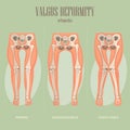 Valgus deformity. Vector medical poster.