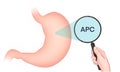 Variants of the APC gene are associated with an increased risk of developing stomach cancer