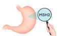 Variants of the MSH2 gene are associated with an increased risk of developing stomach cancer