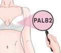 Variants in the PALB2 gene are associated with an increased risk of developing breast cancer