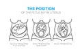 The position of the fetus in the womb Royalty Free Stock Photo