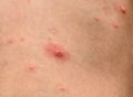 Varicella zoster virus or Chickenpox bubble rash on child, baby Royalty Free Stock Photo