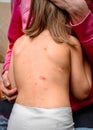 Varicella zoster virus or Chickenpox bubble rash on child, baby
