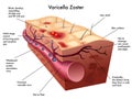 Varicella zoster virus