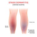 Varicose eczema. Symptoms of venous, gravitational or stasis dermatitis