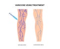 Varicose Injection procedure