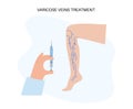 Varicose Injection procedure
