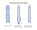 Varicose Injection procedure