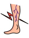 Varicose treatment icon. Violation of circulatory system. Vascular disease diagnostic. Venous insufficiency medical