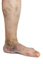 Varicose vein Royalty Free Stock Photo