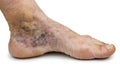 Varicose vein Royalty Free Stock Photo