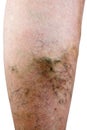 Varicose vein Royalty Free Stock Photo