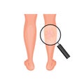 Varicose vein and normal vein. A magnified concept of leg problem