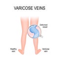 Varicose vein and normal vein