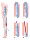 Varicose_veins