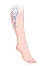 Varicose veins. Blue blood vessel visible through the skin, abnormally swollen leg. Vascular disease diagnostic and