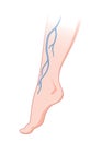 Varicose veins. Blue blood vessel visible through the skin, abnormally swollen leg. Vascular disease diagnostic and