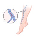 Varicose veins. Blue blood vessel visible through the skin, abnormally swollen leg. Vascular disease diagnostic and