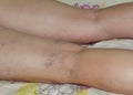 Varicose veins. Capillaries in the leg varicose veins