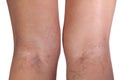 Varicose veins close up