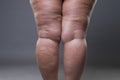 Varicose veins closeup, fat female cellulite legs Royalty Free Stock Photo