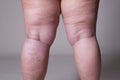 Varicose veins closeup, fat female cellulite legs