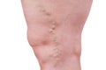 Varicose veins closeup, fat female legs isolated on white background Royalty Free Stock Photo