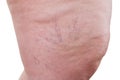 Varicose veins closeup, fat female legs isolated on white background Royalty Free Stock Photo