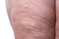 Varicose veins closeup, fat female legs Royalty Free Stock Photo