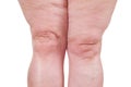 Varicose veins closeup, fat female legs isolated on white background Royalty Free Stock Photo